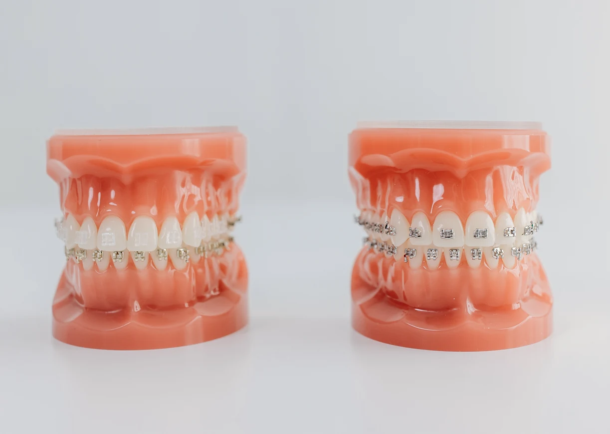 Typodont models with traditional braces
