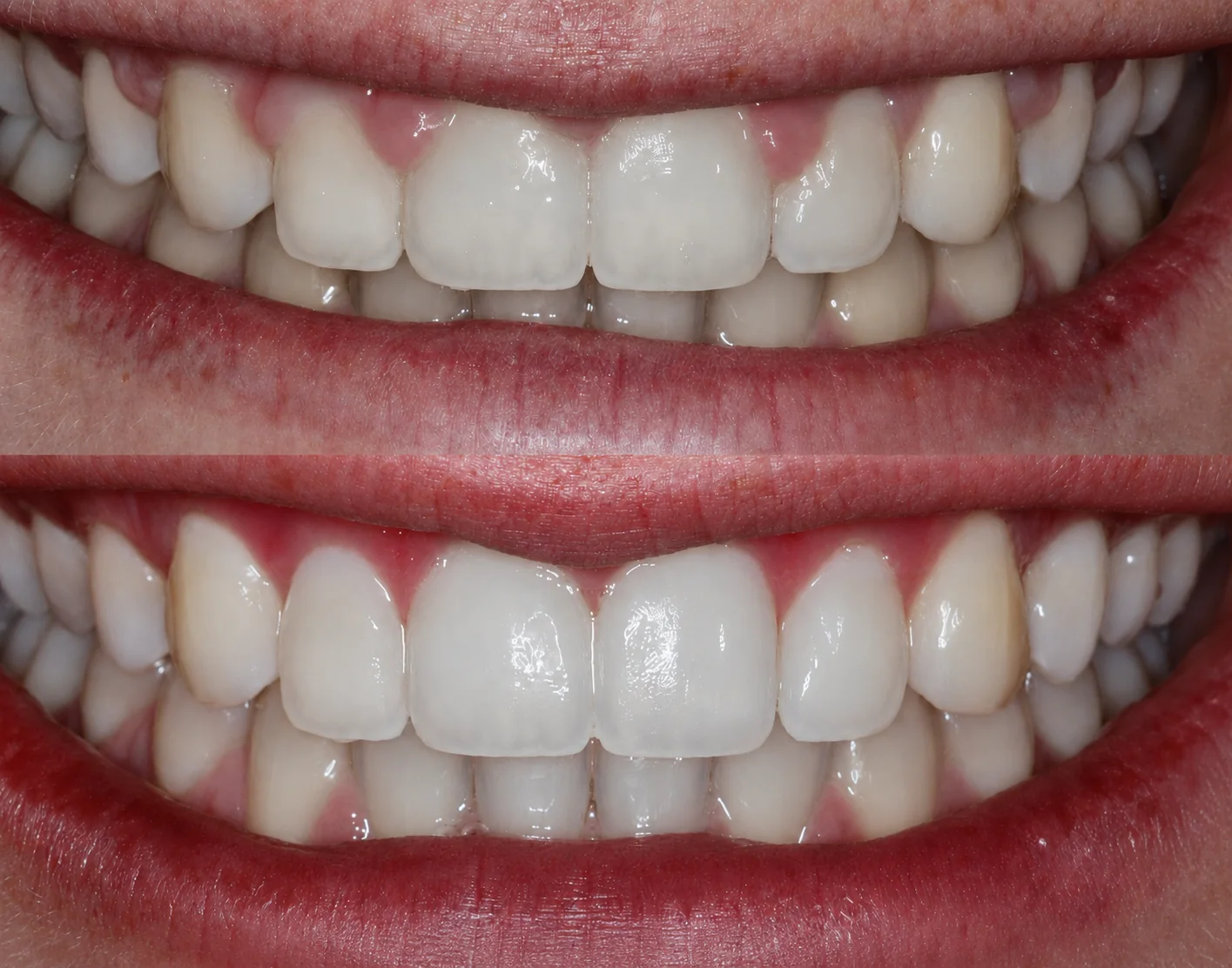 Before and after gingival contouring treatment