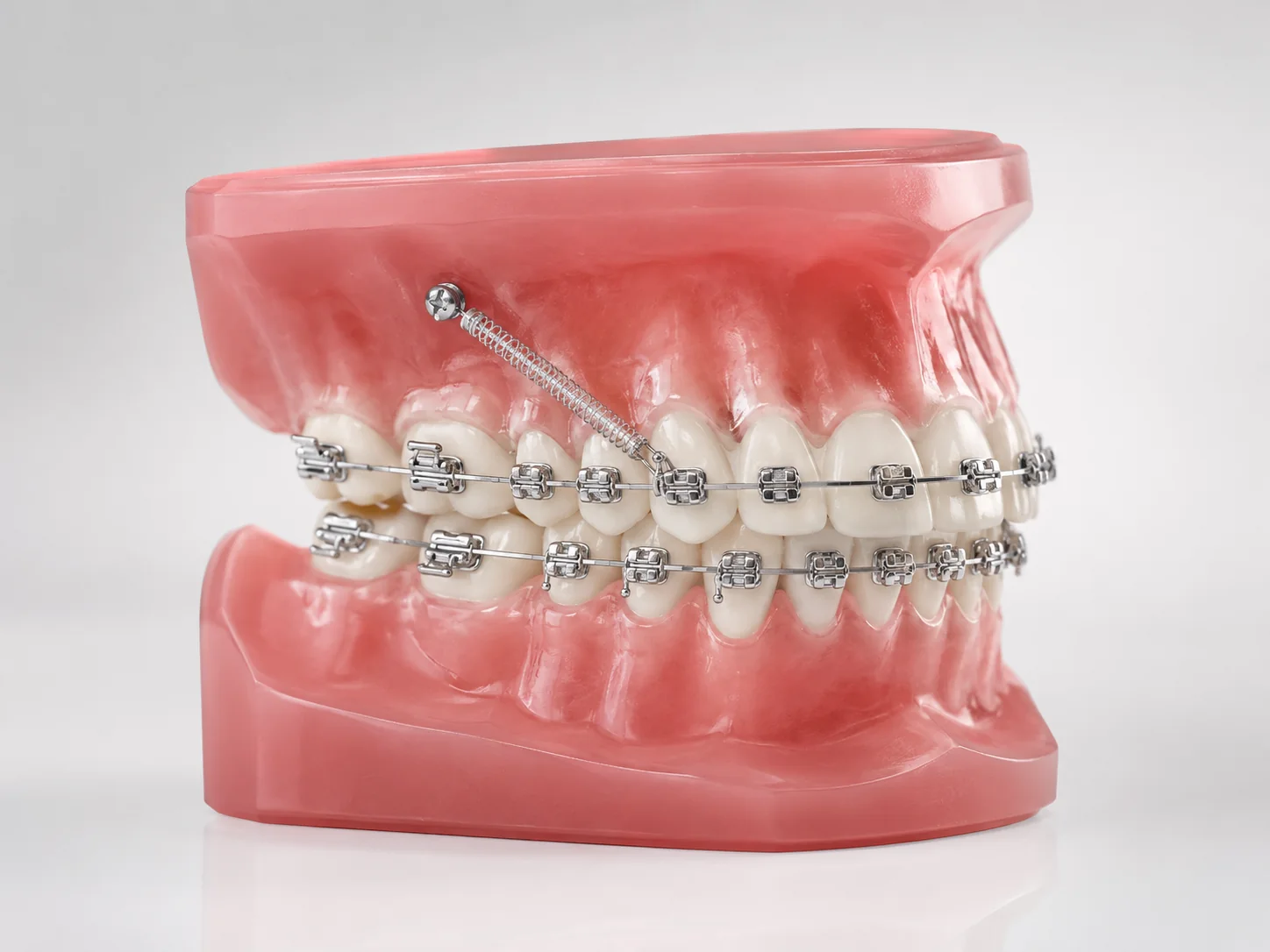 Temporary anchorage device used in orthodontic treatment